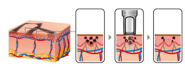 We are here to give you the facts and information you need on. How It Works The Missing Ink Tattoo Removal Professionals