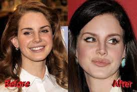But if that perception is part of why people dislike her, it smacks of . Lana Del Rey Plastic Surgery Before And After2 Lana Del Rey Lana Del Rey Surgery Plastic Surgery