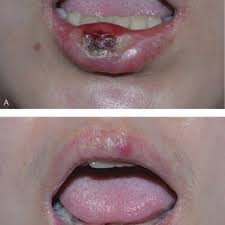 What types of stds cause symptoms in mouth? Pdf Syphilitic Chancre Of The Lips Transmitted By Kissing A Case Report And Review Of The Literature
