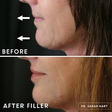 Plastic surgery in miami 305.860.0717. Gallery Before And After Photos By Dr Sarah Hart