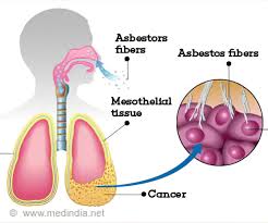 Lung cancer has two broad types: Mesothelioma Causes Symptoms Diagnosis Treatment Prevention