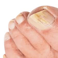 Image result for Koilonychia feet