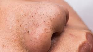 The video, posted on ladbible, shows jacob acosta, 23, literally squeezing every single blackhead out of his nose in the span of two seconds. Deep Blackheads Causes Treatment And Prevention