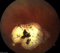 Histoplasmosis Retinopathy The Low Vision Centers Of Indiana