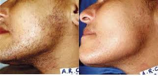 However, it can help to get a first waxing treatment. Laser Hair Removal St Petersburg Permanent Hair Removal Tampa Bay