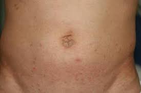 Image result for scabies in the groin area