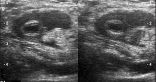 Pin On Appedicitis Omental Infarction