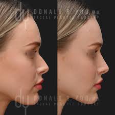 nonsurgical rhinoplasty