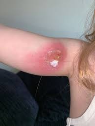 There are more than 40,000 species of spiders in the world — and only 12 of the 500 species that bite have venom strong enough to harm humans. Girl 6 Left With Huge Tangerine Sized Abscess After Spider Bite At Funfair Mirror Online