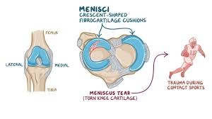 Ppt causes constant abduction and external rotation of the femur, which places continuous misloading onto the medial meniscus and locks the knee in maximal internal tibial rotation. Meniscus Tear Osmosis