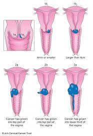 Cervical cancer occurs in cervical cancer may not produce any symptoms or signs. Grading And Staging Cervical Cancer Jo S Cervical Cancer Trust