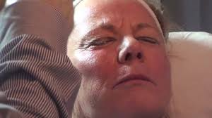 Dr. Vivek performs facial volume restoration, mouthlines and jawline  contouring