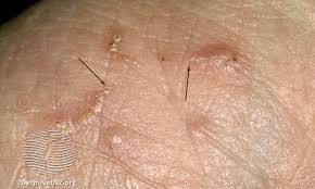 Image result for scabies symptoms