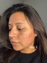 Micro Needling Before and After Acne Scars