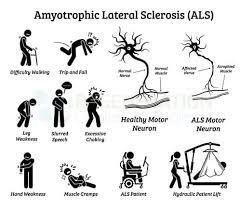 What is amyotrophic lateral sclerosis? Neurogenic Stem Cell Treatment Of Als W Msc Stem Cells