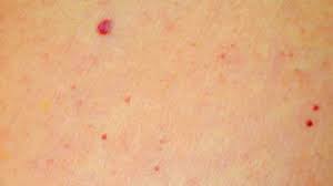 Las manchas rojas en la piel consisten en la aparición de cambios de color en la misma, haciendo que aparezcan zonas en las que, habiendo o no regiones abultadas u otras alteraciones dermatológicas, la piel adquiere una tonalidad rojiza más o menos intensa. Que Son Los Puntos Rojos En La Piel Vivir Mejor