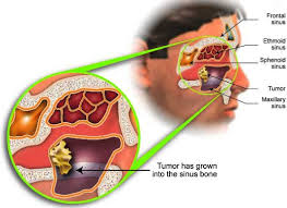 Paranasal sinus cancer can form in any of the sinuses, including the frontal sinuses (above the nose in the forehead), ethmoid sinuses (in the area between the eyes and nose), sphenoid sinuses (behind the. Nasal Cavity Cancer Treatment In India Cost Treatment Surgery Top Hospital Best Doctors In India