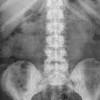 Symptoms can sometimes be noticed for the first time when the cancer advances. 1