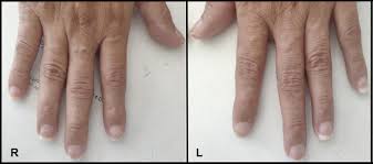 Lecture in internal medicine for v course students. Half And Half Nails In A Patient With Graves Disease The American Journal Of Medicine