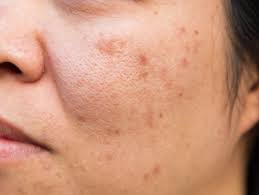 Maybe you would like to learn more about one of these? Akne Naturlich Behandeln Deutsche Gesellschaft Fur Hautgesundheit