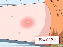 Blasenbildung im bereich der haut, rötung, juckreiz, lethargie, fieber oder hypothermie. Symptome Einer Mrsa Infektion Erkennen 13 Schritte Mit Bildern Wikihow