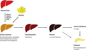 Displaying 8 worksheets for liver diagram. Human And Molecular Genetics Shed Lights On Fatty Liver Disease And Diabetes Conundrum Tavaglione 2020 Endocrinology Diabetes Amp Metabolism Wiley Online Library