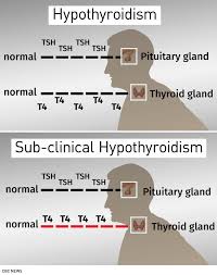 Why Doctors Now Warn Against Routinely Treating Mild Thyroid