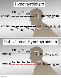 why doctors now warn against routinely treating mild thyroid