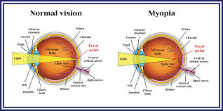 Image result for Refractive Error