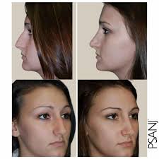 Rhinoplasty Skillman