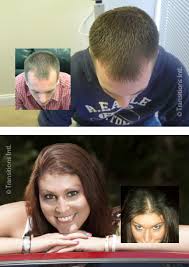 With regular and repeated lllt treatments, hair. Laser Hair Regrowth Treatment For Hair Loss Hair Loss Restoration Replacement Raleigh North Carolina
