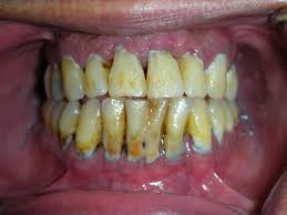 Image result for Periodontitis
