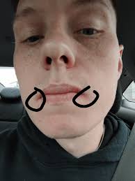 Skin Concerns] Cold Sore SCAR? Help : r/SkincareAddiction