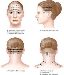 You may feel comfortable waiting until the botox has completely worn off, or you may prefer to schedule repeat treatment as soon as you start to see faint wrinkles cropping up again. Botox For Migraine Who Is It For What Does It Do What Does It Feel Like East Neurology
