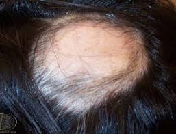 We did not find results for: Dermatita Atopica Si Pielea Foarte Uscata Sos Dermatolog