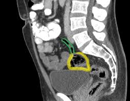 An Unlikely Cause Of Abdominal Pain - The Western Journal Of Emergency  Medicine