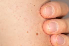 Image result for Keratosis pilaris