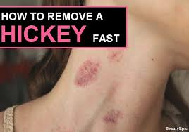 We did not find results for: Top 10 Easy Ways To Get Rid Of A Hickey Overnight Get Rid Of Hickies How To Remove How To Remove Hickey