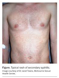 Image result for syphilis symptoms
