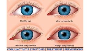 Image result for Allergic Conjunctivitis