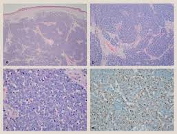 The critical first step is to find a merkel cell carcinoma specialist. Merkel Cell Carcinoma A Review And Update On Current Concepts Diagnostic Histopathology