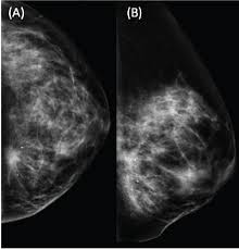 Surgical treatment in oligometastatic breast cancer
