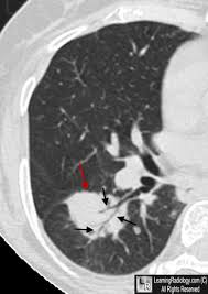 Image result for Air Bronchogram