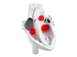 New Guidelines Call For Less Use Of Surgery To Treat Heart Valve Disease American Heart Association