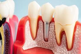 Image result for dental implant