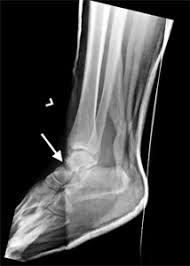 Image result for Talus Fracture