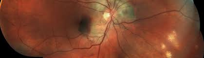 Ocular Histoplasmosis Georgia Retina