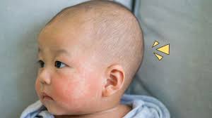 Eczema adalah sejenis penyakit yang berkaitan alahan kulit. Eksim Pada Bayi Ini Pemicu Dan Cara Meredakannya Orami