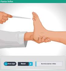 Image result for Babinski Reflex