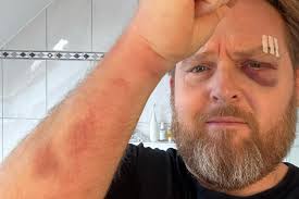 Axel Stein: Autsch! Der Schauspieler kassiert ein übles Veilchen